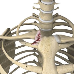 Sternoclavicular Joint Reconstruction
