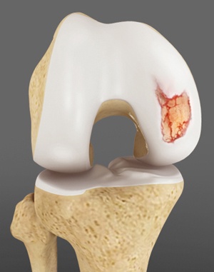 Articular Cartilage Injury
